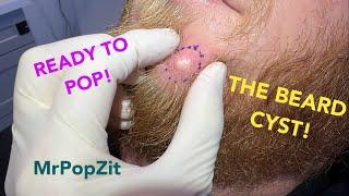 The bearded cyst!Increasing in size and pressure,it was time to go!See the suture removal at the end