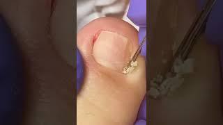 thick nail dry skin and ingrown cleaning at home