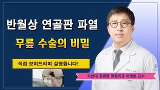 반월상 연골판 파열  무릎 수술의 비밀 / 가천대 길병원 정형외과 이병훈 교수