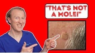 That's not a mole! Uncovering the Mystery of Seborrheic Keratosis