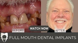 Robert's All on 4 Dental Implants Experience! Life changing dentistry
