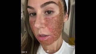 ACNE SCAR COMBO