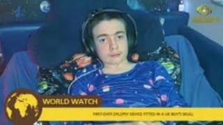 UK Boy Receives First-Ever Skull-Implanted Device, Bridge Collapses, Manchester Airport Resumes +
