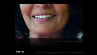 Zirconia Crown | Full Mouth Rehabilitation | Smile Transformation | 64 Year old female | Anand