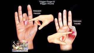 Trigger Finger & Trigger Thumb - Everything You Need To Know - Dr. Nabil Ebraheim