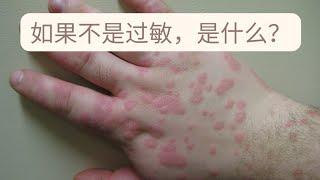 Erythema Multiforme：很像过敏的一种皮肤红疹。如何区别诊断，如何治疗，多久能好？