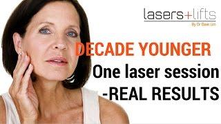 Laser resurfacing - one decade younger