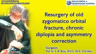 Resurgery of old zygomatico orbital fracture, chronic diplopia and asymmetry correction