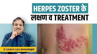 Herpes Zoster Symptoms and Treatment. Dr Sandesh Gupta. 99908 04085