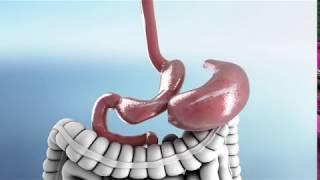 Gastric Sleeve Revision Surgery Animation