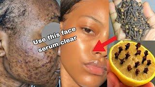 Mix Clove with Lemon to look younger than your age clear acne blemishes scars & get a glowing skin