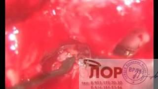 ЛОР врач проводит реоперацию на среднем ухе. Часть 1..mp4