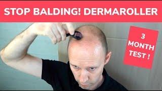 STOP BALDING! - Dermaroller 3 Month Test and Tutorial