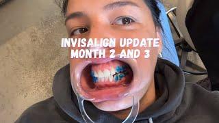 Invisalign update | month 2 and 3 | Invisalign buttons review