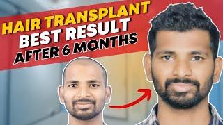 Hair Transplant in Chennai | Best Results & Cost of Hair Transplant in Chennai