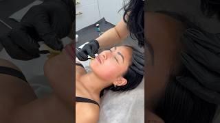 the process of getting a chemical peel #chemicalpeel #skincare #acnescars #skintreatment #skin