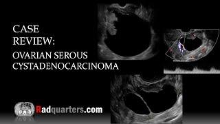 Ultrasound of Ovarian Serous Cystadenocarcinoma
