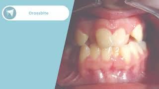 Crossbite Treatment Before / After - Forest & Ray - Dentists, Orthodontists, Implant Surgeons