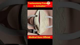 Tracheostomy Proceger In Animation Video #medicalshorts #youtubeshorts #medical guru official