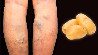 You will say goodbye to varicose veins foreverA tool everyone should have!