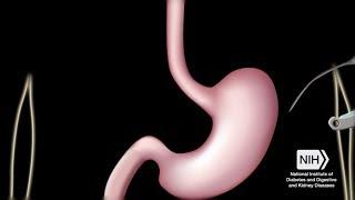 What is Bariatric Surgery?