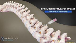 3D Surgery Animation of Spine Injury Portrays Spinal Cord Stimulator Implant