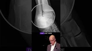 Ankle injury - Maisonneuve fracture