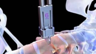 PRESTIGE® Cervical Disc Animation: Neurologic & Orthopedic Hospital of Chicago