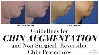 General Guidelines for Chin Augmentation, and Achieving Chin Projection without Surgery