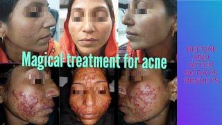 Magical acne peel || Nodulo-cystic acne treatment @DrArifMDDermatologist #acnetreatment  #chemicalpeel