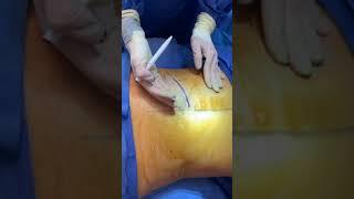 Lipoma Removal