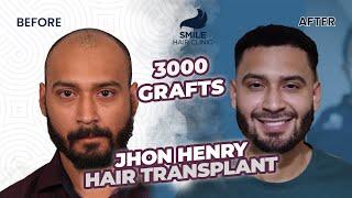 Captivating Transformation: 3000 Grafts Hair Transplant Before and After  Stunning 12-Month Results!