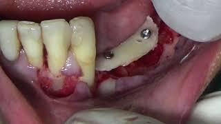 Shell Technique for Vertical Ridge Augmentation