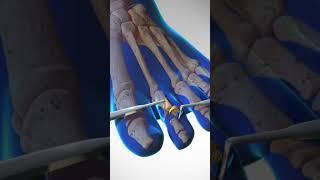 Can't Touch this Surgery: Fixing Hammer Toe