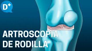 ¿En qué consiste la Artroscopia de rodilla?