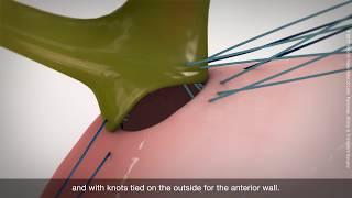 Roux-en-Y hepaticojejunostomy technique