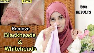 3steps mein Blackheads, Whiteheads & clogged pores sab khatam   --  #teensdiaries