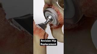 Revision Hip Replacement (3D Animation)
