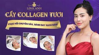 CẤY COLLAGEN TƯƠI giải pháp triệt để cho làn da nám, tàn nhang | HỆ THỐNG THẨM MỸ QUỐC TẾ LINH ANH