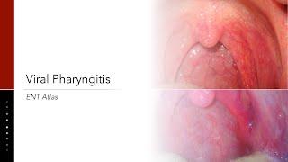 Viral Pharyngitis