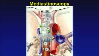 The Role of EBUS in Lung Cancer Staging