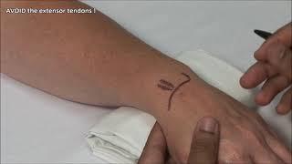 Wrist (Radiocarpal Joint) Injection