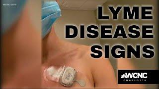 Do you know the signs of Lyme disease?