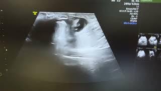 Ultrasound of strangulated umbilical hernia showing omental herniation with fluid.