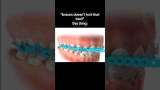 Top 5 Most PAINFUL Things About Braces! 