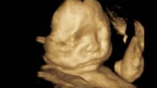 4D Scan, 4D Ultrasound - Dublin Ireland