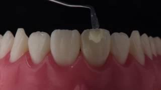 Anterior Restoration with Zenit Nano Ceramic Composite