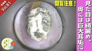 【耳そうじ】Vol.81 見た目は綺麗め、奥には巨大耳垢⁉️