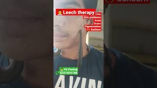 leech therapy for skin problems #ayurveda #shorts #pimples #scars #acne #hairfall #bhopal #mp #up