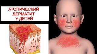 Атопический Дерматит у Детей. Лечение и Профилактика